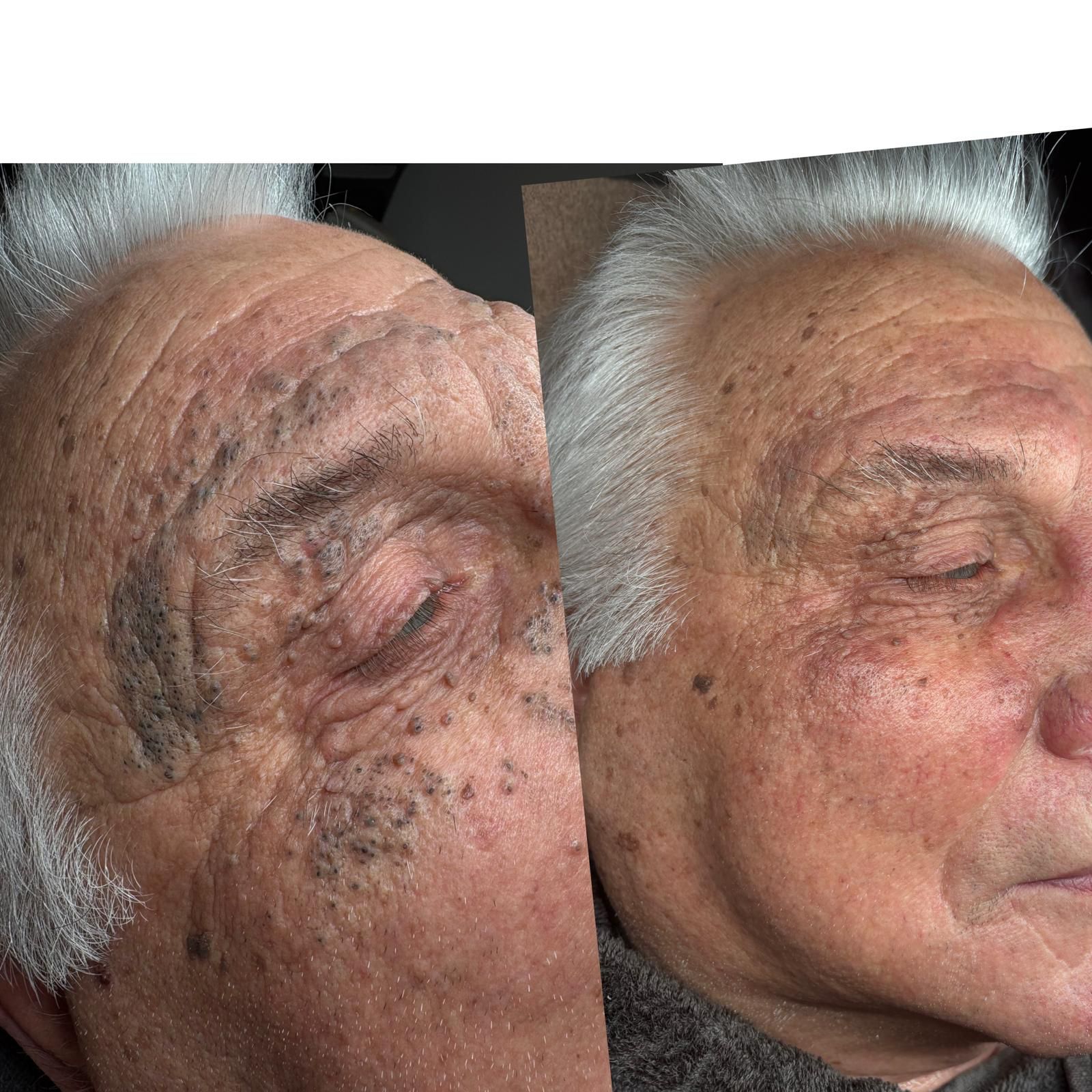 Foto van Dieptereiniging + Carbonlaserpeel