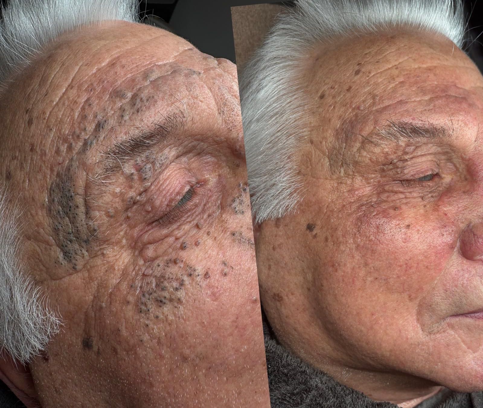 Foto van Dieptereiniging + Carbonlaserpeel