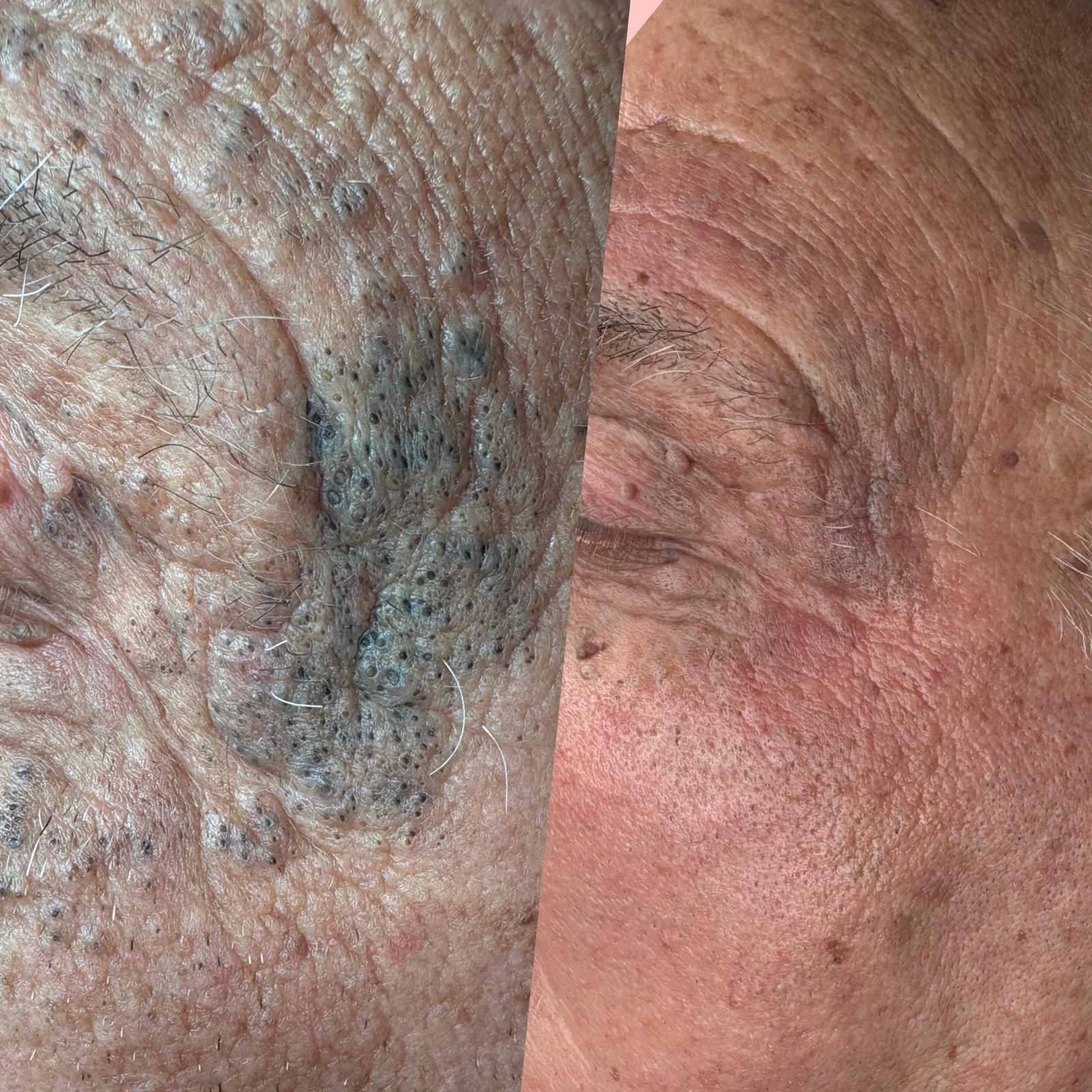 Foto van Dieptereiniging + Carbonlaserpeel